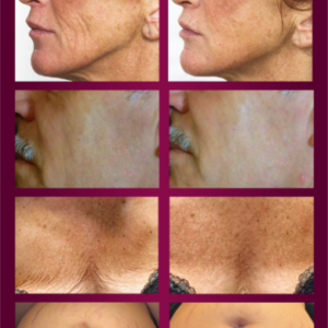 WiQo Italian Peel – Series of 3