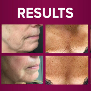 WiQo T33 Italian Peel Facial (Single)