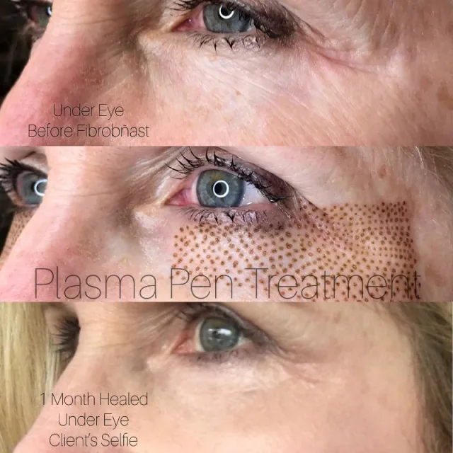 Under Eyes Fibroblasting